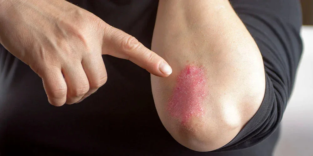 Liệu pháp giảm đau, viêm cho người bệnh viêm khớp vẩy nến